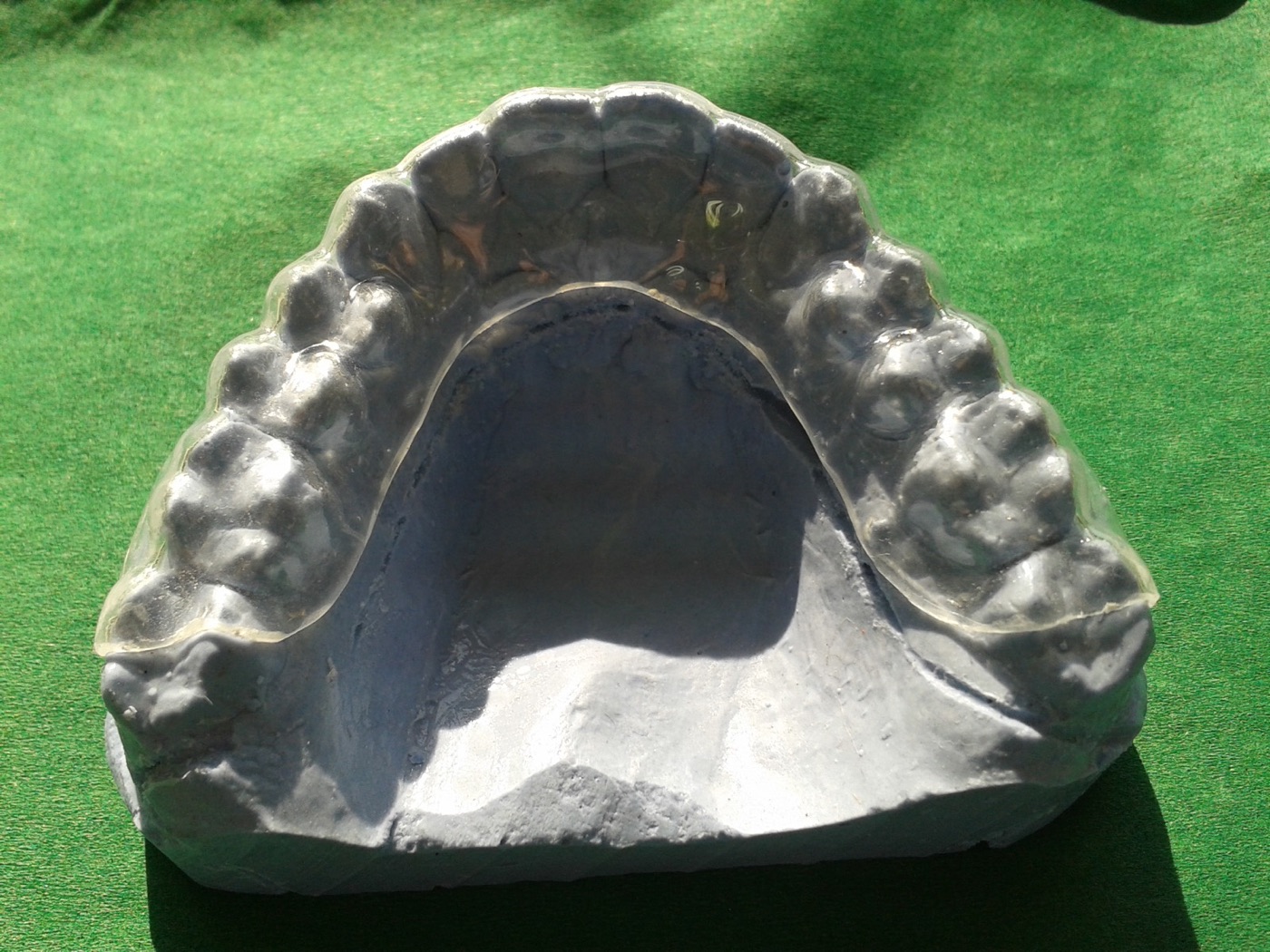 Dentalna udlaga 008